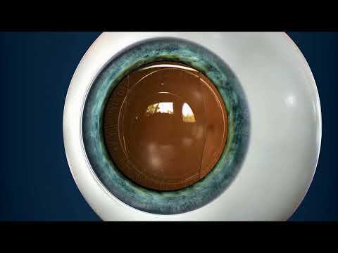 Видео: Факичные линзы: всё, что нужно знать! #факичные #доктор #коррекциязрения