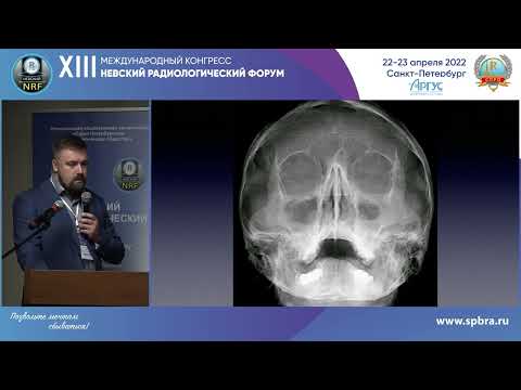 Видео: ОСОБЕННОСТИ ЛУЧЕВОЙ ДИАГНОСТИКИ СИНУСИТОВ РАЗЛИЧНОЙЭТИОЛОГИИ