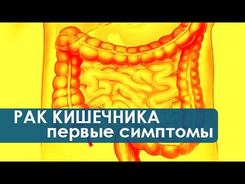 Видео: Симптомы рака кишечника. Как проявляются первые симптомы рака кишечника. Колопроктология