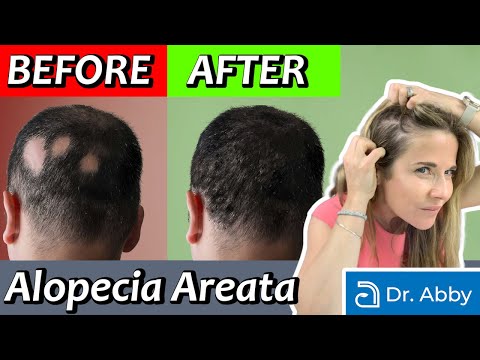 Видео: Гнездная алопеция: причины и лечение от дерматолога