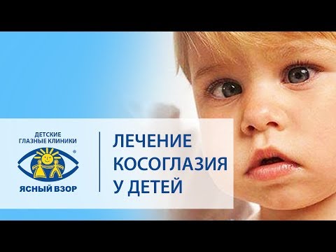 Видео: Косоглазие у детей. 👀 Современное успешное лечение косоглазия у детей. Ясный взор.