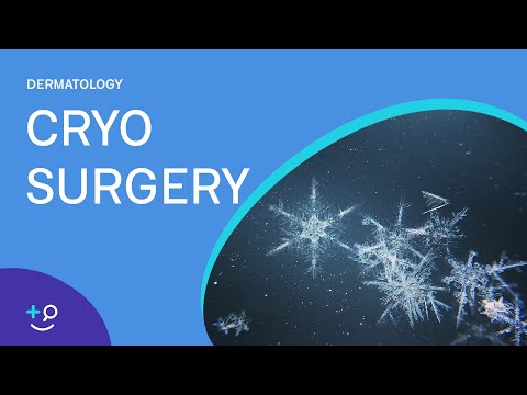 Видео: Процедура криохирургии (замораживание)
