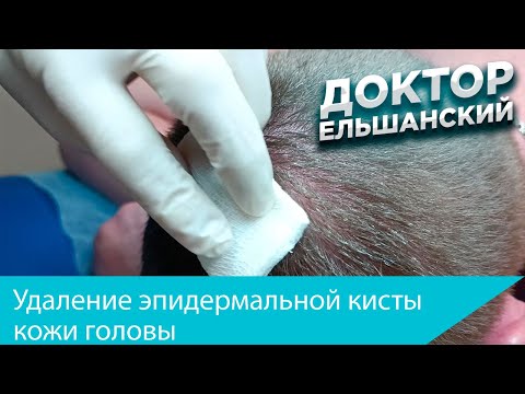 Видео: Удаление эпидермальной кисты (атеромы) головы. Removal of atheroma (cyst) of the scalp