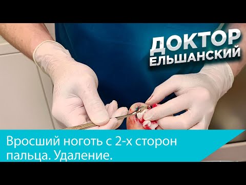 Видео: Вросший ноготь с 2 х сторон пальца, удаление