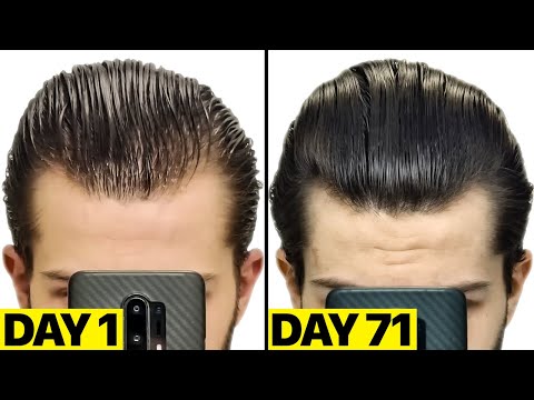 Видео: Мои БЕЗУМНЫЕ результаты финастерида и миноксидила за 2,5 месяца