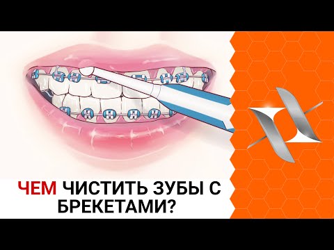 Видео: ЧЕМ ЧИСТИТЬ ЗУБЫ С БРЕКЕТАМИ | Где купить? Что выбрать?