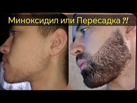 Видео: Миноксидил или Пересадка бороды ?! Мой личный опыт. Выпуск 81 Андрей Борода.
