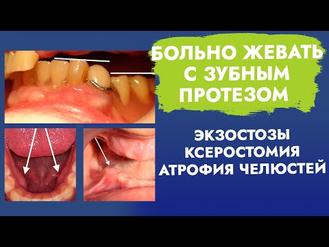 Видео: Больно жевать с зубным протезом. Экзостозы. Ксеростомия. Атрофия челюстей.