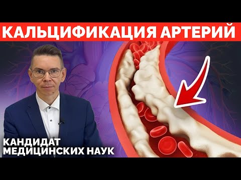 Видео: КАЛЬЦИЙ В АРТЕРИЯХ - ЭТО ГРОЗИТ КАЖДОМУ, ЕСЛИ НЕ ЗНАТЬ ЭТОГО!