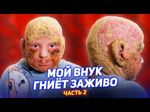 Видео: Мой внук ГНИËТ ЗАЖИВО / "ЧЕШУЯ" вместо кожи / Синдром KID, Ихтиоз / Часть 2 [Добрый Волшебник]