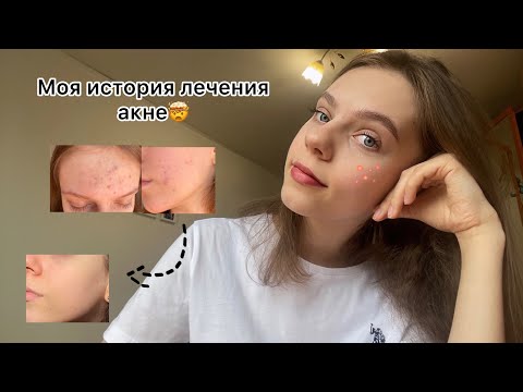Видео: МОЯ ИСТОРИЯ ЛЕЧЕНИЯ АКНЕ|как я вылечила кожу?|мой уход|