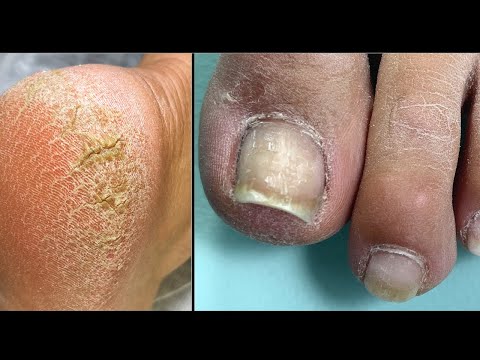 Видео: Сухость/ Трещины / Разросшийся гипонихий 😮