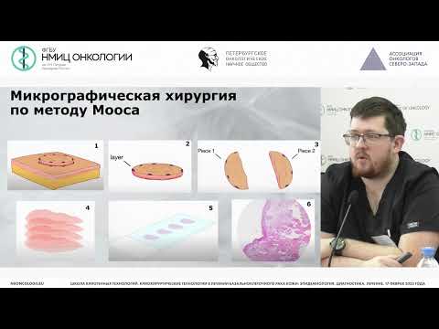 Видео: Клинические рекомендации лечения базальноклеточного рака кожи