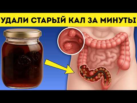 Видео: 1 ложка и Навсегда ЗАБУДЕШЬ о ЗАПОРЕ!