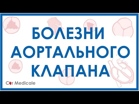 Видео: Болезни аортального клапана: аортальный стеноз, недостаточность аортального клапана.