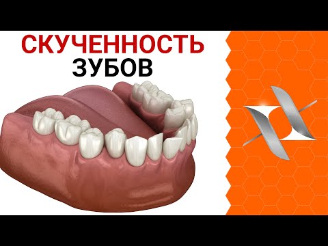 Видео: Скученность и наклон зубов | Почему зубам не хватает места?