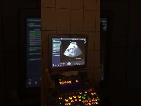 Видео: 16-17 недель беременности мальчик 👶🏻