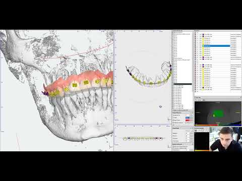 Видео: БОРИС СВИНЦИЦКИЙ - Цифровая фиксация брекетов Forestadent