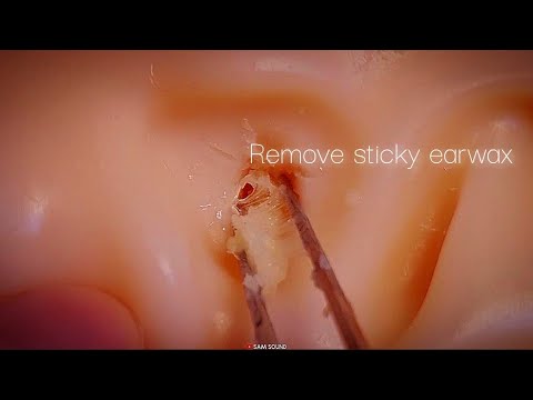 Видео: ASMR Звук, чтобы стимулировать ваше любопытство😎 Удаление липкой и шуршащей ушной серы!!