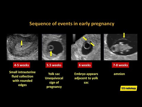 Видео: Ранняя потеря беременности: упрощенный подход с помощью УЗИ