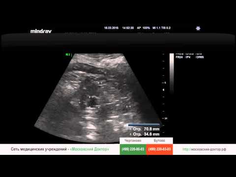 Видео: УЗИ селезёнки