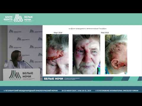 Видео: Лекарственная терапия рецидивирующего базальноклеточного рака кожи (Раджабова З.А.)