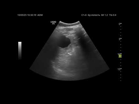 Видео: УЗИ. Доктор Иогансен. Выпуск 63. Неопухолевые очаговые изменения селезенки. Часть 1.