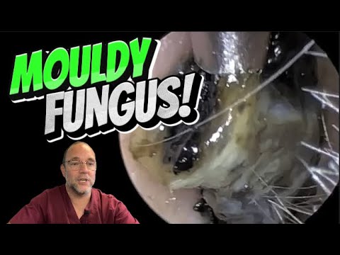 Видео: ГРИБОК С ПЛЕСЕНЬЮ! 333 #ухо #ушнаясера #удалениеушнойсеры #ушнаясера #удовлетворение #длявас #fyp...