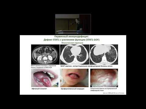 Видео: Редкий вариант первичного иммунодефицита STAT1 GOF у пульмонологического больного