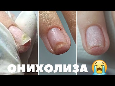 Видео: Онихолиза - възстановяване на отлепен нокът