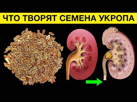 Видео: Что СЕМЕНА УКРОПА сделали с моими ПОЧКАМИ. Что творят семена укропа? Больше вреда, чем пользы?