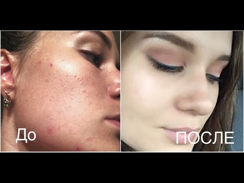 Видео: КАК ИЗБАВИТЬСЯ ОТ ПРЫЩЕЙ В ДОМАШНИХ УСЛОВИЯХ?