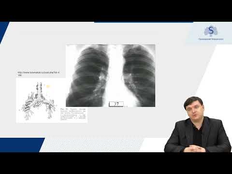 Видео: 2 Первичный период туберкулезной инфекции
