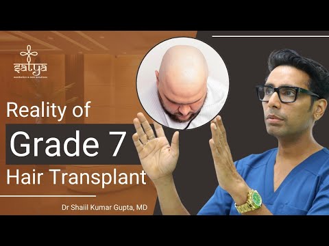 Видео: Пересадка волос при облысении 7 степени | Пересадка волос при облысении 7 степени | Результаты пе...