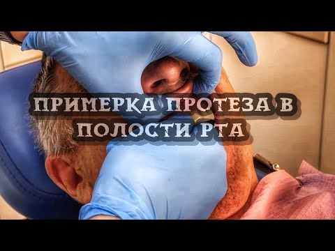 Видео: Примерка и сдача протеза в полости рта/Этапы постановки протеза/Варка протеза .