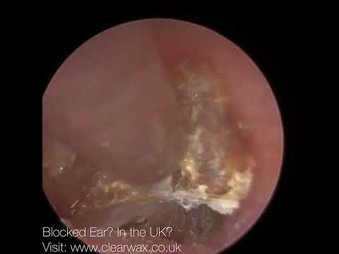 Видео: 1635 – Цементированная омертвевшая кожа, извлеченная из барабанной перепонки