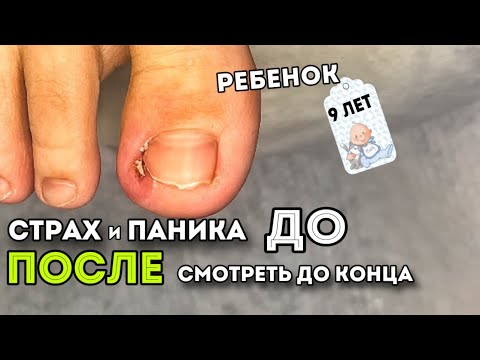 Видео: Истерика, не управляемые эмоции у ребенка при вросшем ногте. Смотреть до конца