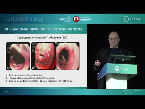 Видео: Ахалазия пищевода