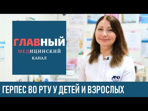 Видео: Герпес во рту: симптомы и лечение герпеса. Как лечить герпес на языке и в горле