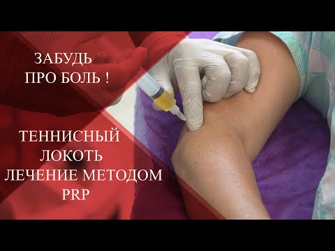 Видео: 💉Латеральный Эпикондилит|Забудь про БОЛЬ в локте |Как лечить суставы PRP!