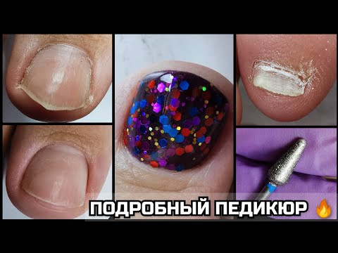 Видео: ПОДОБНЫЙ ПЕДИКЮР💣Обработка ПАЛЬЧИКОВ после зимы❤️УБИРАЕМ УГЛЫ💋новая фреза КАПЛЯ плюсы➕ и минусы➖