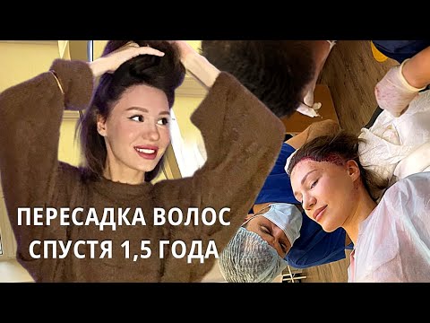 Видео: ПЕРЕСАДКА ВОЛОС СПУСТЯ 1,5 ГОДА | сделала вторую пересадку волос
