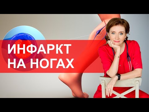 Видео: Инфаркт на ногах