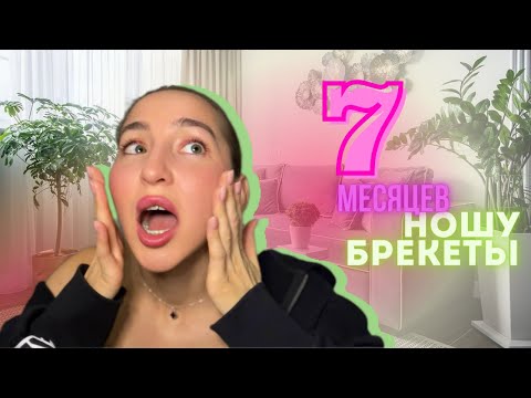 Видео: Цветные лигатуры/эластики🦷⛓️7 месяцев ношу брекеты