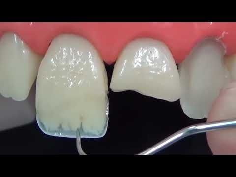 Видео: Прямая реставрация переднего зуба за 3 минуты (ускоренное видео)
