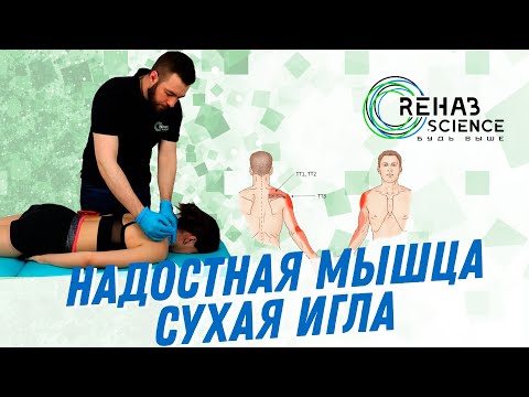 Видео: Работа с надостной мышей методом сухой иглы
