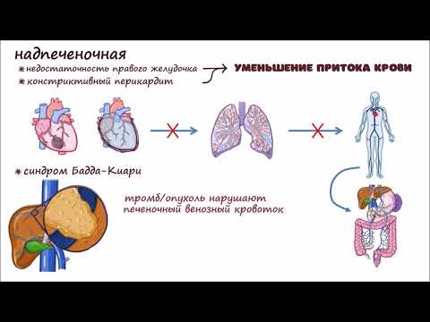 Видео: Портальная Гипертензия