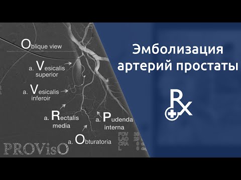 Видео: Эмболизация артерий предстательной железы