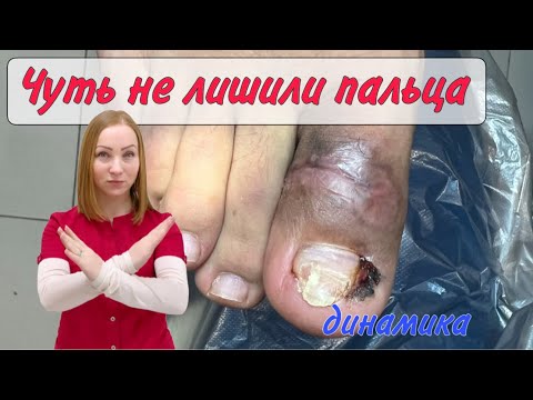 Видео: Как лечить вросший ноготь / врачебная ошибка / опух палец / подолог Москва