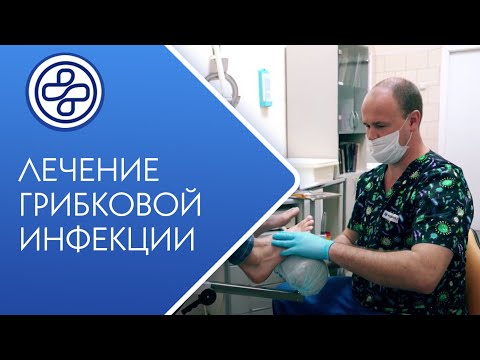 Видео: Подология - грибок ногтей? Подолог - миколог. МНПЦДК.